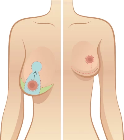 Breast-reduction-1362x1536-1
