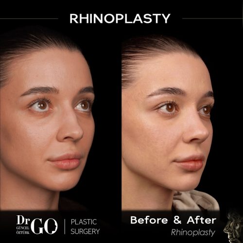Burun Yüz Güzelliğini Etkiler mi?